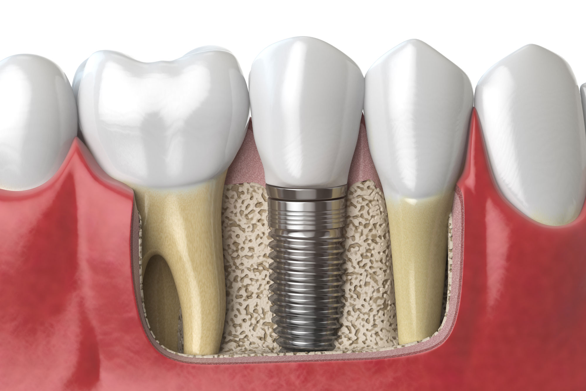Dental Implants and Oral Surgery in Cudahy