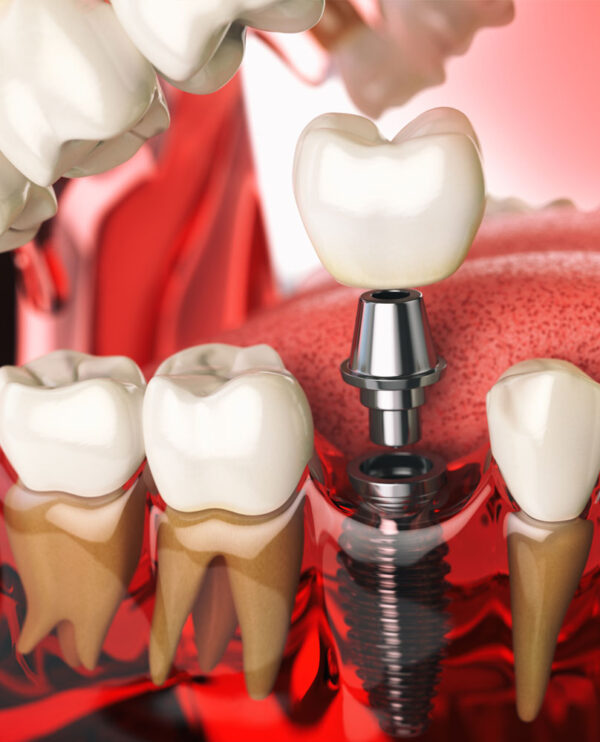 Implants and Oral Surgery Cudahy Dental Associates
